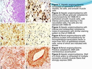  Figure 1. Hepatic angiomyolipoma
composed of admixture of blood
vessels, fat cells, and smooth muscle
cells
 Figure 2.Hepatic angiomyolipoma with
strong and diffuse granular cytoplasmic
immunoreactivity for HMB-45 in
epithelioid smooth muscle cells, with
intense perinuclear staining in the
vacuolated cells. Fat cells are not
stained with HMB-45
 Figure 3.Hepatic angiomyolipoma with
intense and widespread cytoplasmic
melan-A expression with similar staining
pattern to that of HMB-45
 Figure 4.Renal angiomyolipoma with
positive nuclear immunoreactivity for
microphthalmia transcription factor in
more than 50% of epithelioid smooth
cells, some of which are indicated with
arrows
 Figure 5.Renal angiomyolipoma.
Positive cytoplasmic SMA with
membranous accentuation
 Figure 6.Hepatic angiomyolipoma. Wall
of a thick artery is composed of multiple
concentric smooth muscle fibers that
strongly express SMA
 