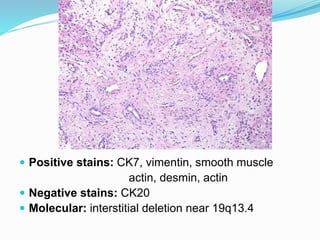  Positive stains: CK7, vimentin, smooth muscle
actin, desmin, actin
 Negative stains: CK20
 Molecular: interstitial deletion near 19q13.4
 