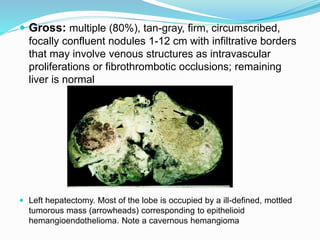  Gross: multiple (80%), tan-gray, firm, circumscribed,
focally confluent nodules 1-12 cm with infiltrative borders
that may involve venous structures as intravascular
proliferations or fibrothrombotic occlusions; remaining
liver is normal
 Left hepatectomy. Most of the lobe is occupied by a ill-defined, mottled
tumorous mass (arrowheads) corresponding to epithelioid
hemangioendothelioma. Note a cavernous hemangioma
 