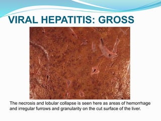 VIRAL HEPATITIS: GROSS
The necrosis and lobular collapse is seen here as areas of hemorrhage
and irregular furrows and granularity on the cut surface of the liver.
 