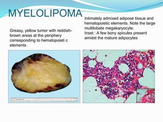 MYELOLIPOMA
Greasy, yellow tumor with reddish-
brown areas at the periphery
corresponding to hematopoieti c
elements
Intimately admixed adipose tissue and
hematopoietic elements. Note the large
multilobate megakaryocyte.
Inset : A few bony spicules present
amidst the mature adipocytes
 