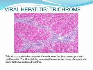 VIRAL HEPATITIS: TRICHROME
This trichrome stain demonstrates the collapse of the liver parenchyma with
viral hepatitis. The blue-staining areas are the connective tissue of many portal
tracts that have collapsed together.
 