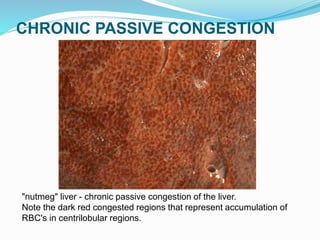 CHRONIC PASSIVE CONGESTION
"nutmeg" liver - chronic passive congestion of the liver.
Note the dark red congested regions that represent accumulation of
RBC's in centrilobular regions.
 