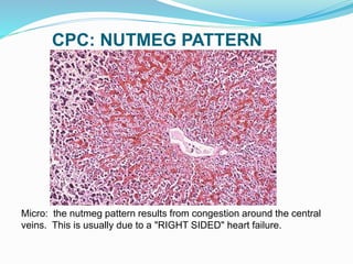 CPC: NUTMEG PATTERN
Micro: the nutmeg pattern results from congestion around the central
veins. This is usually due to a "RIGHT SIDED" heart failure.
 