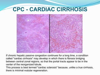 CPC - CARDIAC CIRRHOSIS
If chronic hepatic passive congestion continues for a long time, a condition
called "cardiac cirrhosis" may develop in which there is fibrosis bridging
between central zonal regions, so that the portal tracts appear to be in the
center of the reorganized lobule.
This process is best termed "cardiac sclerosis" because, unlike a true cirrhosis,
there is minimal nodular regeneration.
 