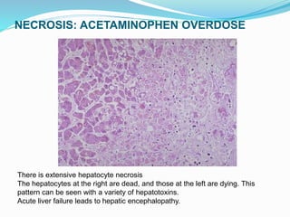 NECROSIS: ACETAMINOPHEN OVERDOSE
There is extensive hepatocyte necrosis
The hepatocytes at the right are dead, and those at the left are dying. This
pattern can be seen with a variety of hepatotoxins.
Acute liver failure leads to hepatic encephalopathy.
 