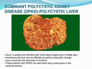 DOMINANT POLYCYSTIC KIDNEY
DISEASE (DPKD)-POLYCYSTIC LIVER
- Occur in adults and manifest with renal failure beginning in middle age –
- Sometimes the liver can be affected as well by polycystic change.
- Less commonly the pancreas is involved.
- These patients with DPKD can also have berry aneurysms in the
cerebral arteries.
 
