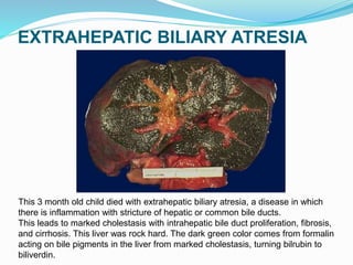 EXTRAHEPATIC BILIARY ATRESIA
This 3 month old child died with extrahepatic biliary atresia, a disease in which
there is inflammation with stricture of hepatic or common bile ducts.
This leads to marked cholestasis with intrahepatic bile duct proliferation, fibrosis,
and cirrhosis. This liver was rock hard. The dark green color comes from formalin
acting on bile pigments in the liver from marked cholestasis, turning bilrubin to
biliverdin.
 
