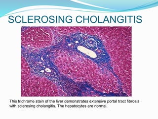 SCLEROSING CHOLANGITIS
This trichrome stain of the liver demonstrates extensive portal tract fibrosis
with sclerosing cholangitis. The hepatocytes are normal.
 