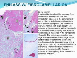 FNH ASS W/ FIBROLAMELLAR CA
53-y/o woman
A solitary fibrolamellar CA measuring 8 cm
found in the resected left lobe. Left,
Immediately adjacent to the carcinoma (C)
was a 15-mm, well-demarcated nodule of
focal nodular hyperplasia (H). Most of the
liver was normal, with slight atrophy (A)
adjacent to the carcinoma. Within the nodule
is a branched arterial supply. The areas in
rectangles are magnified in the right panels
.Top right, The nodule was supplied by a
large artery (a) derived from a large portal
tract invaded by carcinoma. Carcinoma
invades periarterial tissues (arrows) and a
large hepatic vein (v), causing intimal fibrous
thickening. There is ductular proliferation
adjacent to the arteries LR: 2 nerves
adjacent to the supplying A are invaded and
deformed by tumor.
 