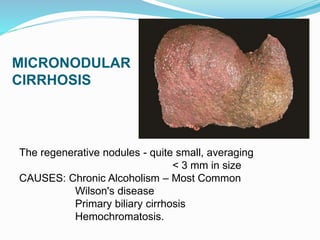 MICRONODULAR
CIRRHOSIS
The regenerative nodules - quite small, averaging
< 3 mm in size
CAUSES: Chronic Alcoholism – Most Common
Wilson's disease
Primary biliary cirrhosis
Hemochromatosis.
 