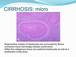 CIRRHOSIS: micro
Regenerative nodules of hepatocytes are surrounded by fibrous
connective tissue that bridges between portal tracts.
Within this collagenous tissue are scattered lymphocytes as well as a
proliferation of bile ducts.
 
