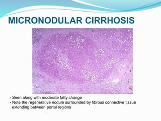 MICRONODULAR CIRRHOSIS
- Seen along with moderate fatty change
- Note the regenerative nodule surrounded by fibrous connective tissue
extending between portal regions
 