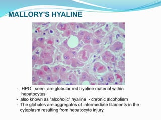 MALLORY'S HYALINE
- HPO: seen are globular red hyaline material within
hepatocytes
- also known as "alcoholic" hyaline - chronic alcoholism
- The globules are aggregates of intermediate filaments in the
cytoplasm resulting from hepatocyte injury.
 