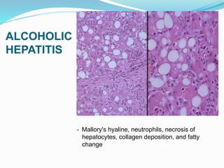 ALCOHOLIC
HEPATITIS
- Mallory's hyaline, neutrophils, necrosis of
hepatocytes, collagen deposition, and fatty
change
 
