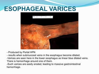 ESOPHAGEAL VARICES
- Produced by Portal HPN
- results when submucosal veins in the esophagus become dilated.
-Varices are seen here in the lower esophagus as linear blue dilated veins.
There is hemorrhage around one of them.
-Such varices are easily eroded, leading to massive gastrointestinal
hemorrhage.
 