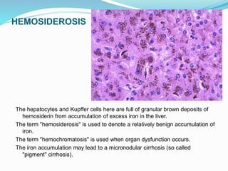 HEMOSIDEROSIS
The hepatocytes and Kupffer cells here are full of granular brown deposits of
hemosiderin from accumulation of excess iron in the liver.
The term "hemosiderosis" is used to denote a relatively benign accumulation of
iron.
The term "hemochromatosis" is used when organ dysfunction occurs.
The iron accumulation may lead to a micronodular cirrhosis (so called
"pigment" cirrhosis).
 