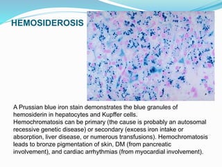HEMOSIDEROSIS
A Prussian blue iron stain demonstrates the blue granules of
hemosiderin in hepatocytes and Kupffer cells.
Hemochromatosis can be primary (the cause is probably an autosomal
recessive genetic disease) or secondary (excess iron intake or
absorption, liver disease, or numerous transfusions). Hemochromatosis
leads to bronze pigmentation of skin, DM (from pancreatic
involvement), and cardiac arrhythmias (from myocardial involvement).
 