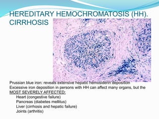 HEREDITARY HEMOCHROMATOSIS (HH).
CIRRHOSIS
Prussian blue iron: reveals extensive hepatic hemosiderin deposition
Excessive iron deposition in persons with HH can affect many organs, but the
MOST SEVERELY AFFECTED:
Heart (congestive failure)
Pancreas (diabetes mellitus)
Liver (cirrhosis and hepatic failure)
Joints (arthritis)
 
