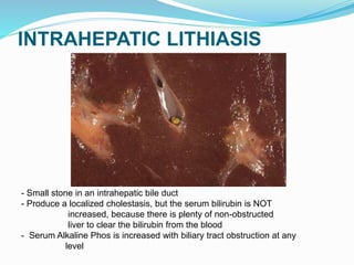 INTRAHEPATIC LITHIASIS
- Small stone in an intrahepatic bile duct
- Produce a localized cholestasis, but the serum bilirubin is NOT
increased, because there is plenty of non-obstructed
liver to clear the bilirubin from the blood
- Serum Alkaline Phos is increased with biliary tract obstruction at any
level
 