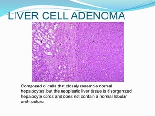 LIVER CELL ADENOMA
Composed of cells that closely resemble normal
hepatocytes, but the neoplastic liver tissue is disorganized
hepatocyte cords and does not contain a normal lobular
architecture
21
 