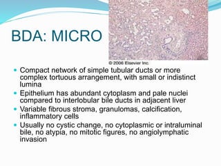 BDA: MICRO
 Compact network of simple tubular ducts or more
complex tortuous arrangement, with small or indistinct
lumina
 Epithelium has abundant cytoplasm and pale nuclei
compared to interlobular bile ducts in adjacent liver
 Variable fibrous stroma, granulomas, calcification,
inflammatory cells
 Usually no cystic change, no cytoplasmic or intraluminal
bile, no atypia, no mitotic figures, no angiolymphatic
invasion
 