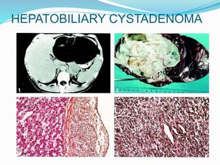 HEPATOBILIARY CYSTADENOMA
 