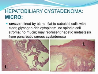HEPATOBILIARY CYSTADENOMA:
MICRO:
 serous - lined by bland, flat to cuboidal cells with
clear, glycogen-rich cytoplasm, no spindle cell
stroma; no mucin; may represent hepatic metastasis
from pancreatic serous cystadenoca
 