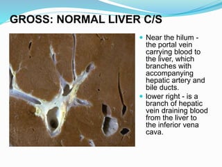  Near the hilum -
the portal vein
carrying blood to
the liver, which
branches with
accompanying
hepatic artery and
bile ducts.
 lower right - is a
branch of hepatic
vein draining blood
from the liver to
the inferior vena
cava.
GROSS: NORMAL LIVER C/S
 