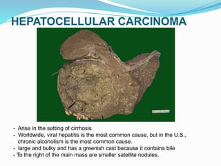 HEPATOCELLULAR CARCINOMA
- Arise in the setting of cirrhosis
- Worldwide, viral hepatitis is the most common cause, but in the U.S.,
chronic alcoholism is the most common cause.
- large and bulky and has a greenish cast because it contains bile
- To the right of the main mass are smaller satellite nodules.
 