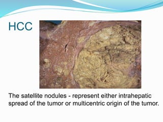 HCC
The satellite nodules - represent either intrahepatic
spread of the tumor or multicentric origin of the tumor.
 