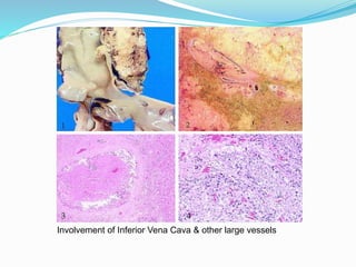 Involvement of Inferior Vena Cava & other large vessels
 