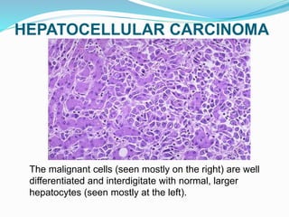 HEPATOCELLULAR CARCINOMA
The malignant cells (seen mostly on the right) are well
differentiated and interdigitate with normal, larger
hepatocytes (seen mostly at the left).
 