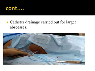 Catheter drainage carried out for larger
abscesses.
 