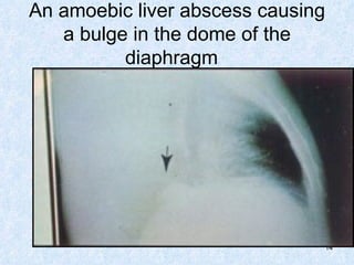 An amoebic liver abscess causing a bulge in the dome of the diaphragm  