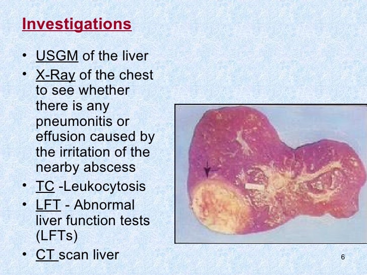 Liver abscess