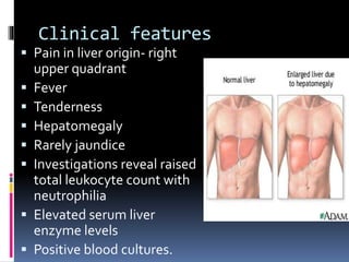Clinical features
 Pain in liver origin- right
upper quadrant
 Fever
 Tenderness
 Hepatomegaly
 Rarely jaundice
 Investigations reveal raised
total leukocyte count with
neutrophilia
 Elevated serum liver
enzyme levels
 Positive blood cultures.
 