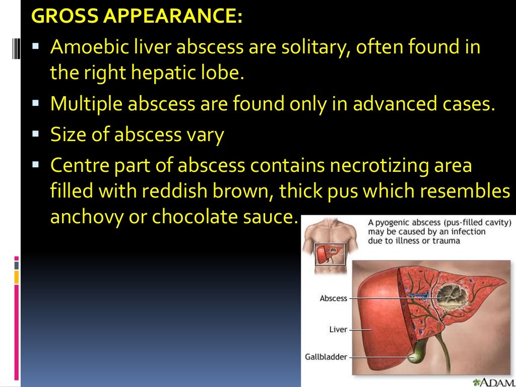 Liver abscess