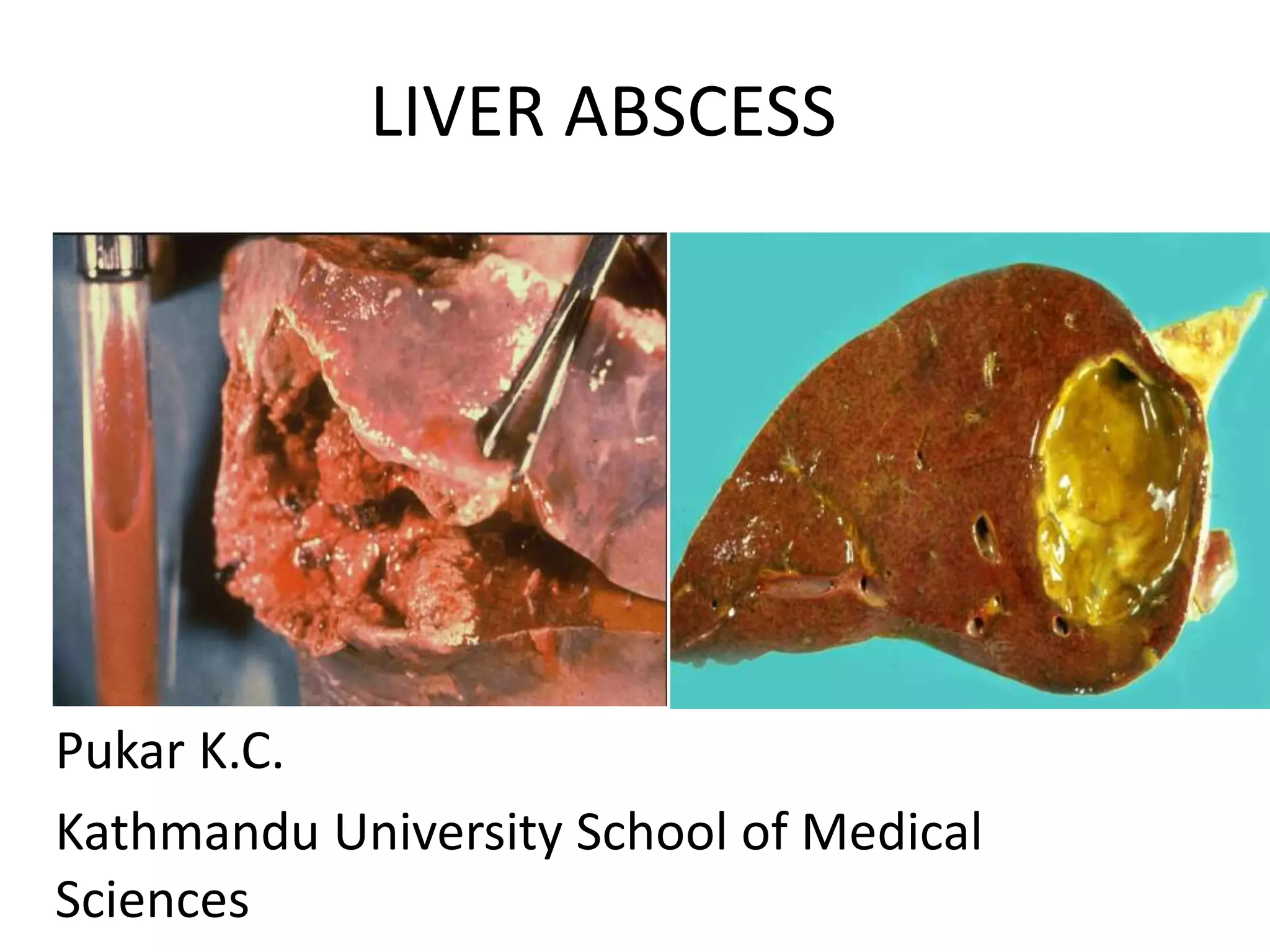 Liver Abscess Ppt