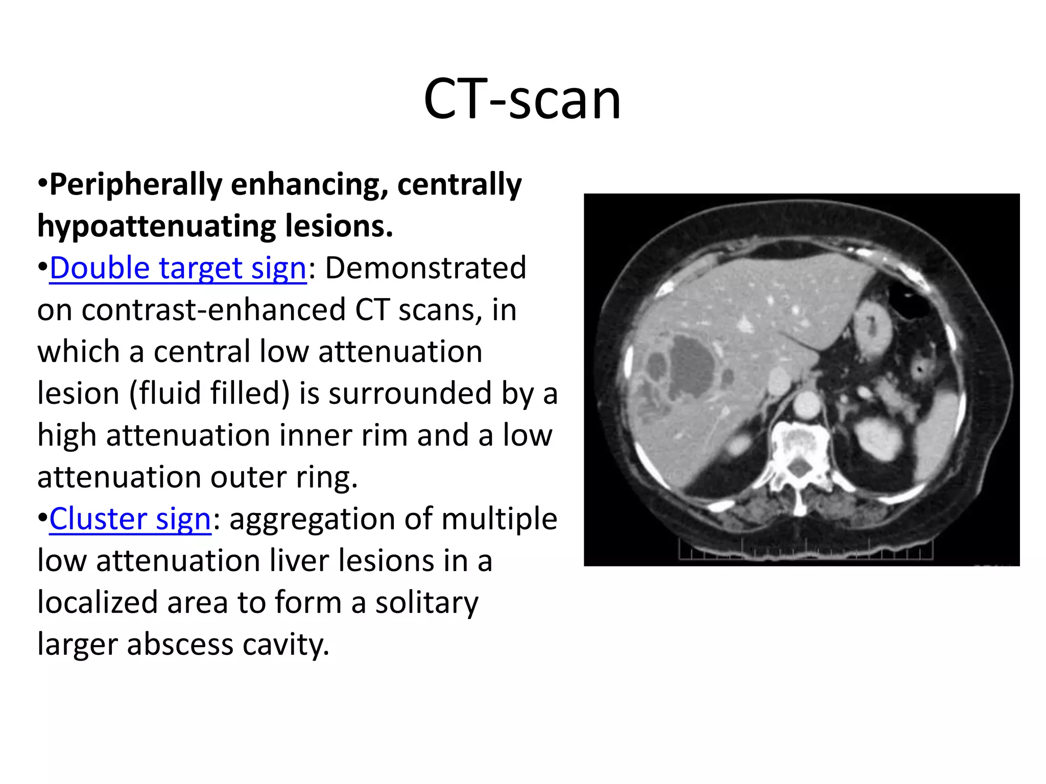 Liver abscess | PPTX