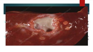 Liver abscess
 A liver abscess is a collection of pus in the liver caused by bacteria, fungi, or
parasites. It may occur as a single lesion or as multiple lesions of different
sizes. The abscess may contain thick, bad smelling pus or reddish-brown
anchovy paste-like fluid with no odor.
 Occurs when bacteria/protozoa destroy hepatic tissue, produces a cavity which
fills up with infective organisms, liquefied cells & leucocytes. Necrotic tissue
then falls off the cavity from rest of the liver.
 