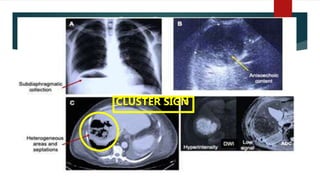 Pyogenic Liver Abscess
CLUSTER SIGN
 