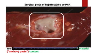 Surgical piece of hepatectomy by PHA
Well circumscribed cavity, with uneven contours, with dark material
(“anchovy paste”) content.
 