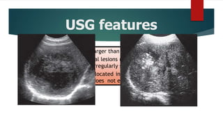 USG features
 Intrahepatic abscesses larger than 2 cm
 Hypoechoic round or oval lesions (still with some internal
echoes however), and irregularly shaped well defined borders
 Limitation in abscesses located in the dome of the liver and
liquefied necrotic area does not enhance
 