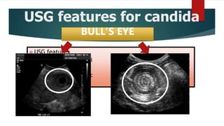 USG features for candida
abscess
 USG features
 Wheel within a wheel
 Bull’s eye
 Uniformly hypoechoic
 Echogenic
BULL’S EYE
 