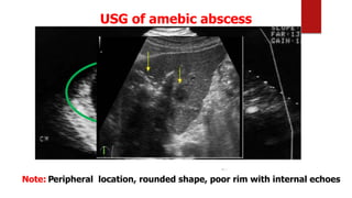 USG of amebic abscess
Note: Peripheral location, rounded shape, poor rim with internal echoes
 