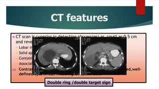 CT features
 CT scan is superior in detecting abscess(es) as small as 0.5 cm
and reveals the abscess as:
 Lobar involvement
 Solid appearance (mimicking a hepatic tumour)
 Contain gas in 20% of lesions
 Association with thrombophlebitis
(a) Contrast-enhanced CT scan demonstrates a large, lobulated,well-
defined cystic mass in the right hepatic lobe.
Double ring /double target sign
 