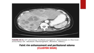 Faint rim enhancement and perilesional edema
(CLUSTER SIGN)
 