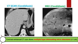 CT SCAN (Candidiasis) MRI (Candidiasis)
Contrast-enhanced CT scan shows multiple hypo attenuating micro abscesses (<1 cm)
 
