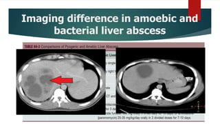 Imaging difference in amoebic and
bacterial liver abscess
 